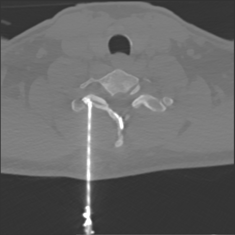 infiltration sous scanner rachis cervical