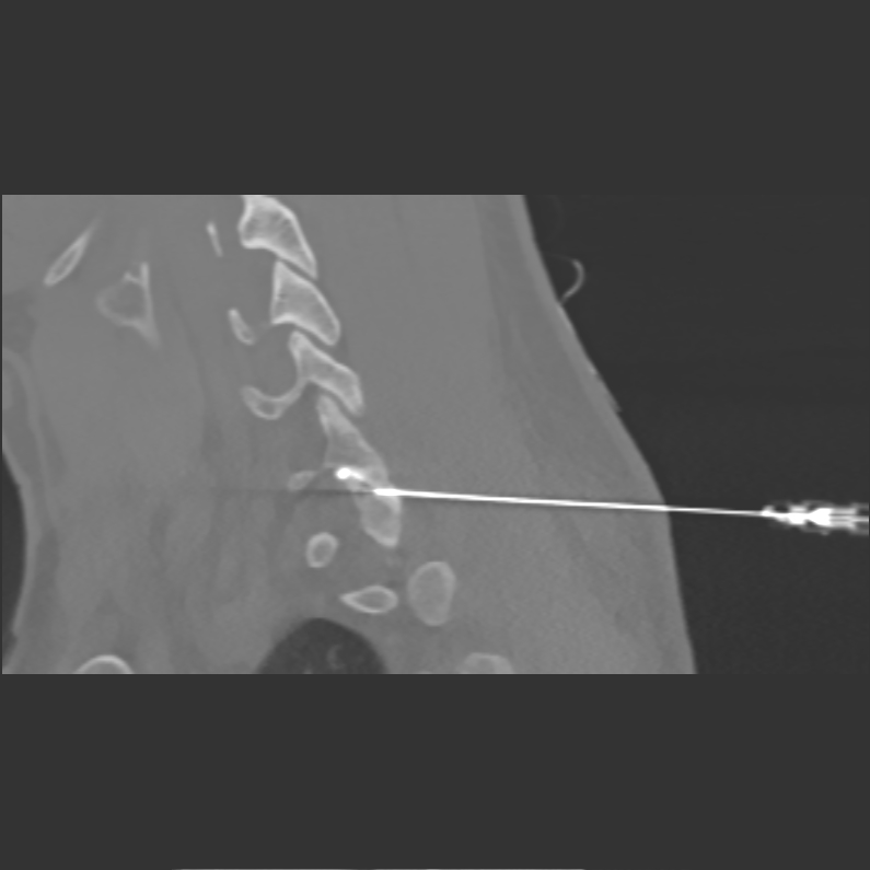 infiltration sous scanner rachis cervical