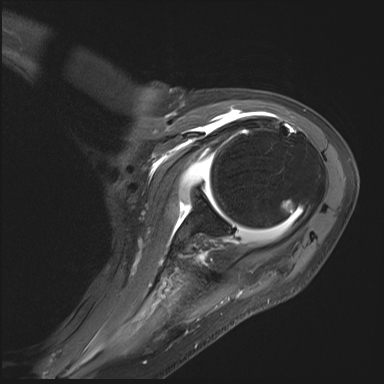 irm-epaule-axial