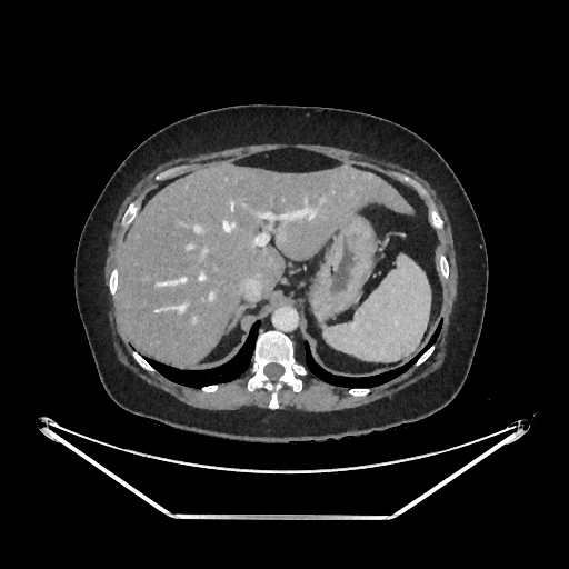Scanner abdominal - Radiologie-Infiltration.ch