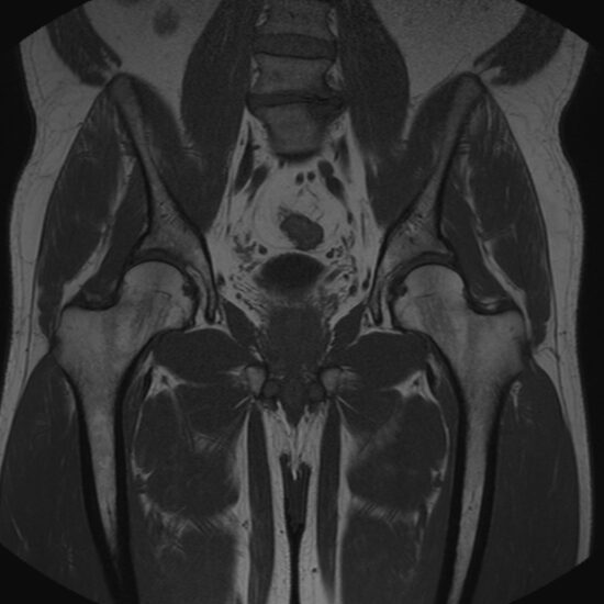 IRM de la hanche RadiologieInfiltration.ch